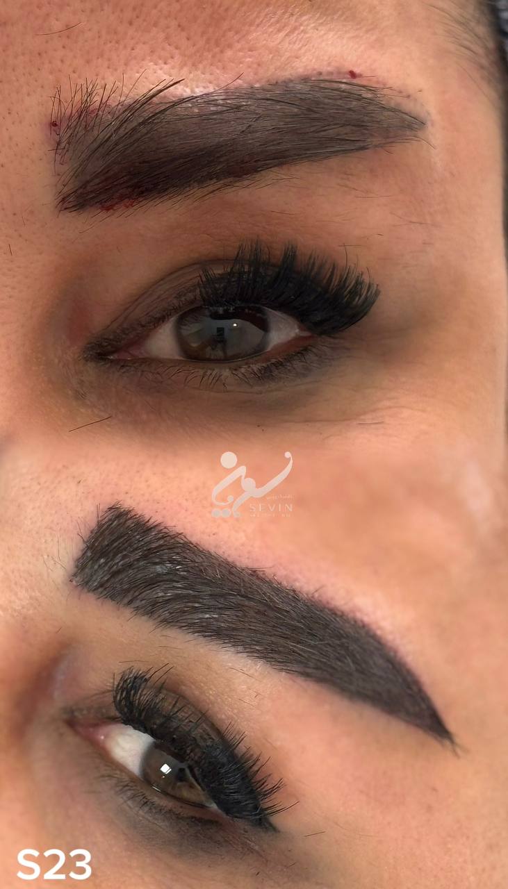 نمونه کاشت ابرو در کلینیک سوین